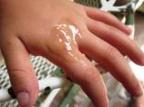 Splinter, Sliver, Stinger, Sticker & Cactus Needle Remedy